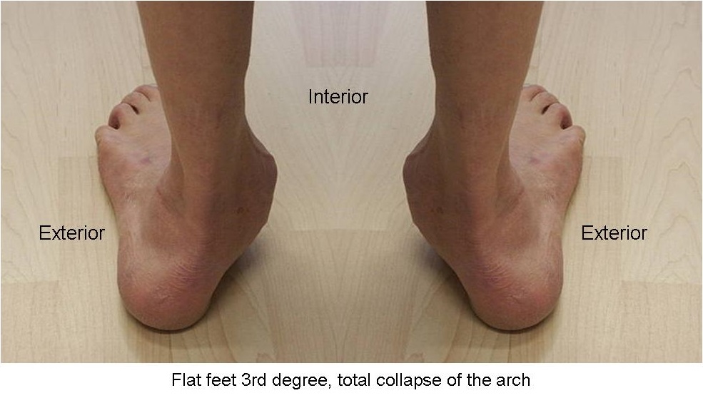 Flat feet clearance and heels